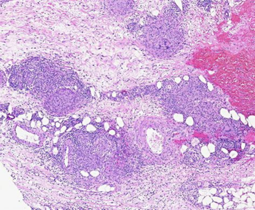 Septal and lobular granulomatous panniculitis composed | Open-i