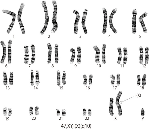 Metaphase karyotype analysis showing isochromosome Xq. | Open-i