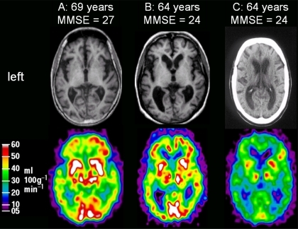 Representative brain scans in FTD-3 patients. Upper row | Open-i