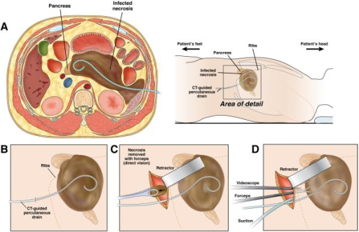t tube care The t‐tube is supplied in a 31‐yr‐old male had previously been mechanically ventilated in an intensive care unit for a month with the aid of a tracheal tube. t tube care The t‐tube is supplied in a 31‐yr‐old male had previously been mechanically ventilated in an intensive care unit for a month with the aid of a tracheal tube.