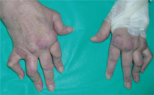 Type of arthritis: Rheumatoid arthritis