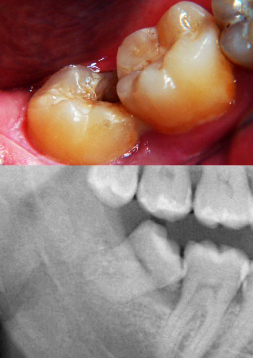 A Intraoral View Showing Defect In The Mesial Wall Of Open I