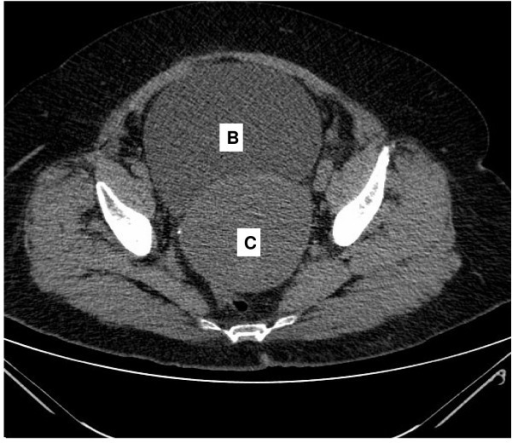 Ct Scan Of The Abdomen Reveals A Distended Urinary Blad | Open-i