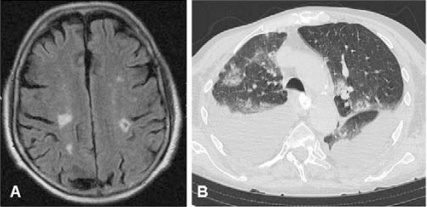 Multiple brain infarcts in a patient with Churg-Strauss | Open-i