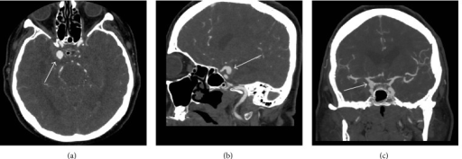 Preoperative CT-Angiogram. CT: computed tomography, CTA | Open-i