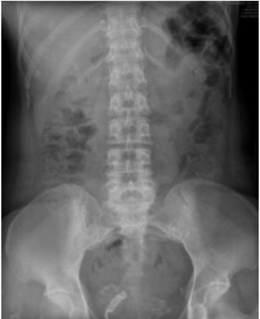 Simple abdominal X-ray shows irregular calcification su | Open-i