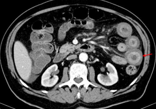 Abdominal CT with contrast shows marked thickening and | Open-i