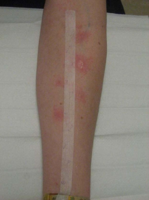 Skin prick test with evaluation of wheal and flare reac Openi Skin prick test with evaluation of wheal and flare reac Openi