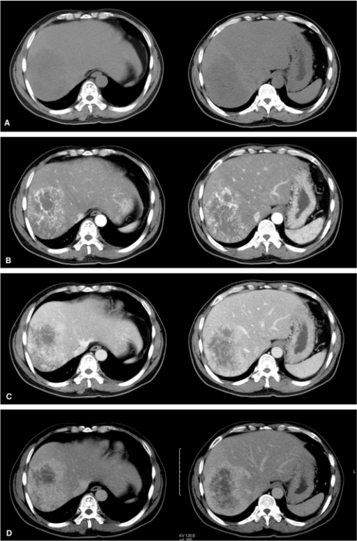 Dynamic Contrast Enhanced Ct Scans A Precontrast Ct Open I
