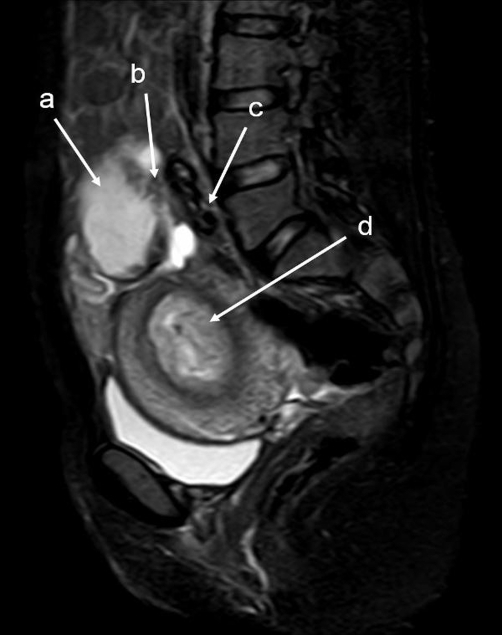 T2W SPAIR sagittal MRI of lower abdomen demonstrating t | Open-i