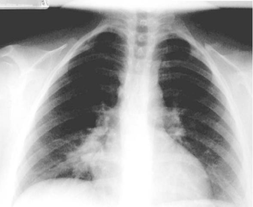 x-ray-of-the-chest-showing-an-infiltrate-in-the-lower-l-open-i