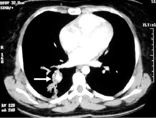 Contrast Enhanced CT Scan Of Chest Showing Pulmonary Ar | Open-i