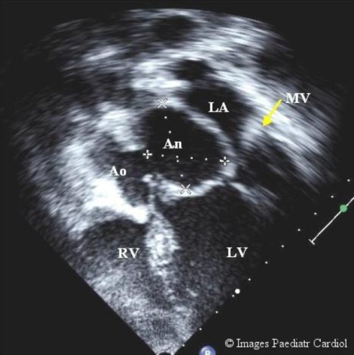 Apical 4 chamber view with anterior tilt (5 chamber vie | Open-i