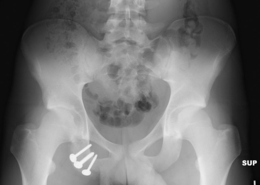 Postoperative Anteroposterior Pelvis Radiograph Showing Open I 