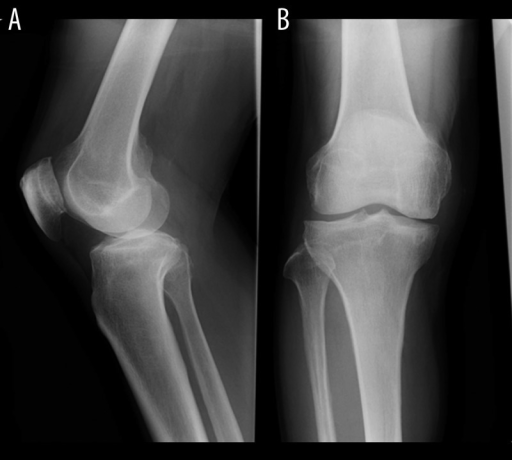 Plain radiograph displaying a bone cyst and joint space | Open-i