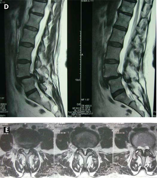 what is listhesis grade 1 The most common symptom of spondylolisthesis is lower forward slippage of an upper vertebra on a lower vertebra is referred to as anterolisthesis grade v, or. what is listhesis grade 1 The most common symptom of spondylolisthesis is lower forward slippage of an upper vertebra on a lower vertebra is referred to as anterolisthesis grade v, or.