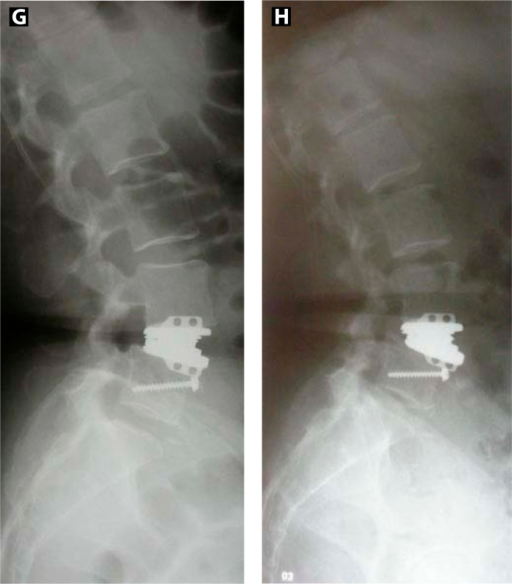 minimal retrolisthesis of minimal retrolisthesis of