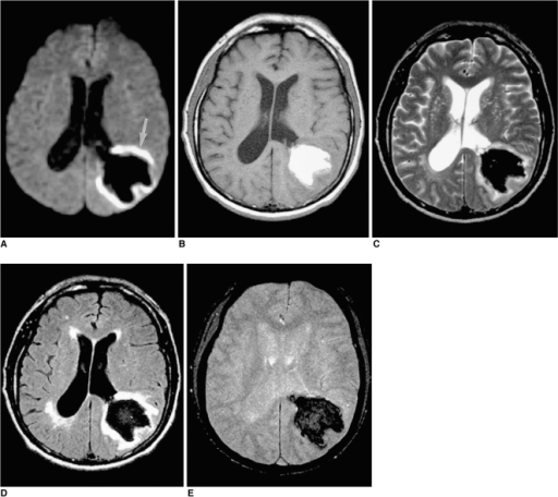 A 56-year-old man with early subacute intracerebral hem | Open-i