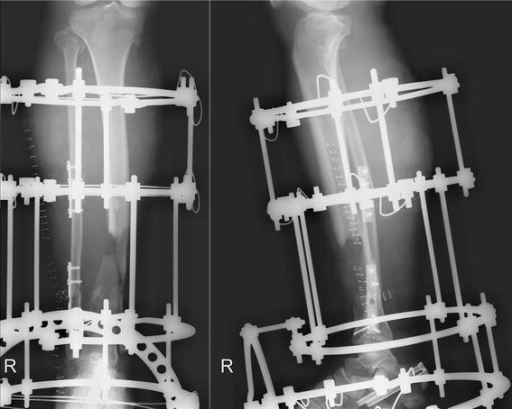 ORIF of the fracture of the fibula and application of a | Open-i