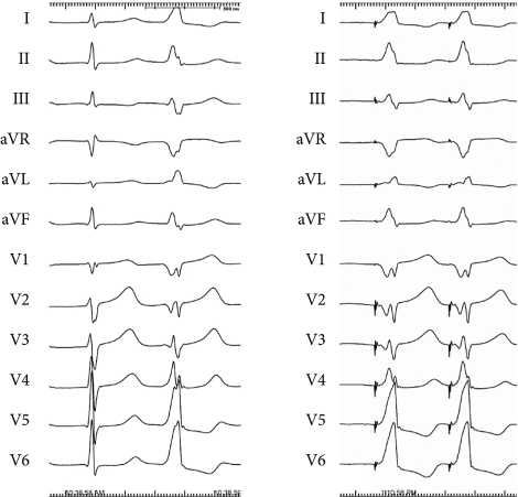 Pacemapping at the successful ablation site. Morphology | Open-i