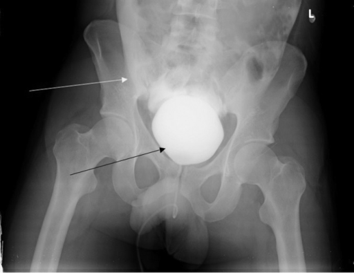 Retrograde Cystogram Bladder Filled With Contrast bot Open i retrograde-cystogram-bladder-filled-with-contrast-bot-open-i
