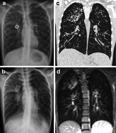 A 15 Year Old Girl With Cystic Fibrosis Examined With T Open I