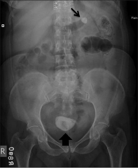 Radiograph of kidneys-ureters-bladder showing radio-opa | Open-i