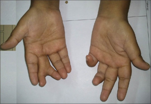 Picture showing central polydactyly in right hand and c | Open-i