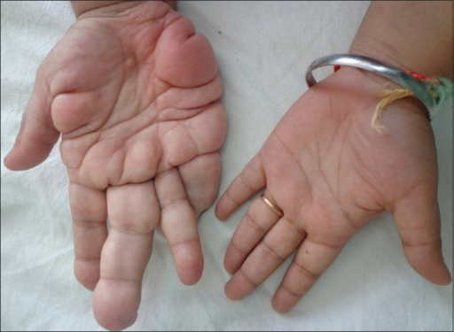 Palmar thickening of right hand with macrodactyly | Open-i