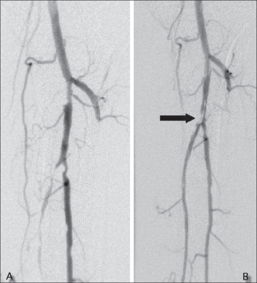 Pre A And Post B Angioplasty Angiograms Of The Dis Open I