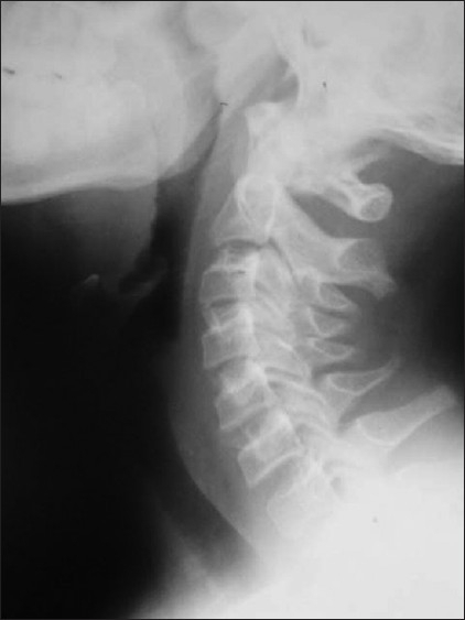 Neck skiagram showing adenoid hypertrophy in the child | Open-i