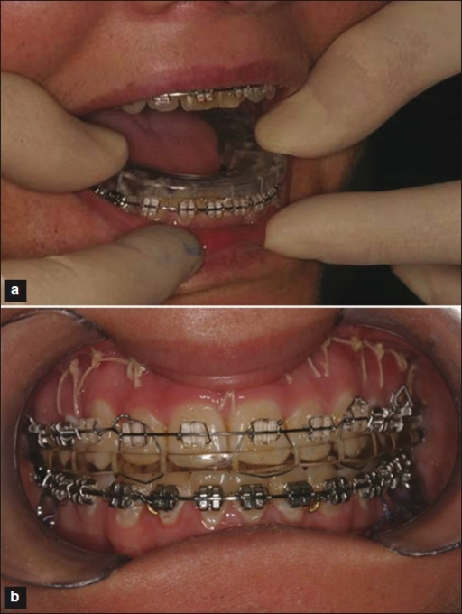 A Surgical Splint For Orthognathic Surgery: (a) Wearing Surgical Splint ...