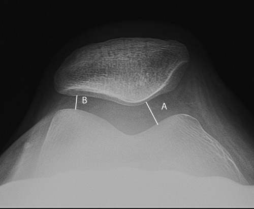 Axial Radiograph Demonstrating Measurement Of The Media | Open-i