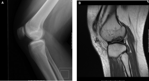 Lateral Radiograph A And Sagittal Proton Density Mri Open I