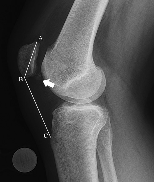 Lateral radiograph demonstrating the Insall-Salvati rat | Open-i