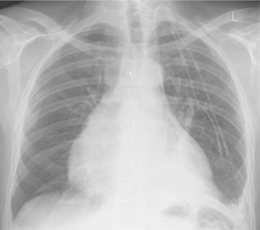 Post-dialysis line insertion. Chest X-ray, postero-ante | Open-i