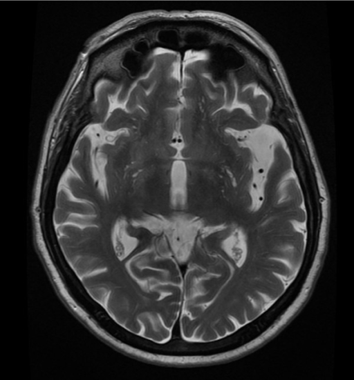 Magnetic resonance imaging. Axial T2-weighted sequence | Open-i