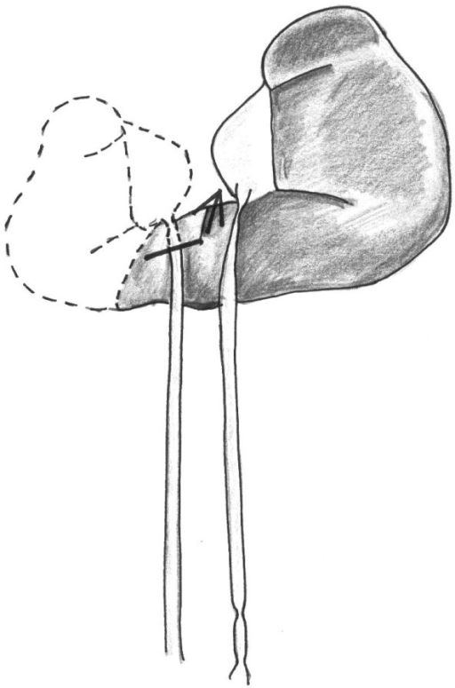 Intraoperative situation. Heminephrectomy of the right | Open-i