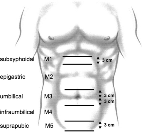 To classify midline incisional hernias between the two | Open-i