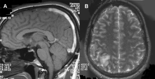 A T1 Weighted Mri The Superior Sagittal Sinus Shows Open I