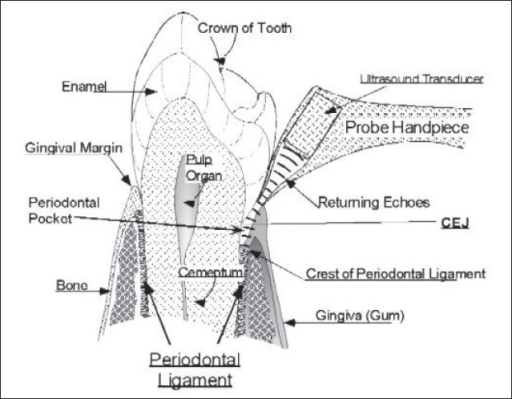 Ultrasonic periodontal probe with probe tip at the ging | Open-i