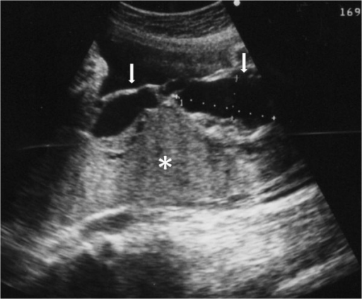 Transabdominal ultrasound study. Placental parenchyma ( | Open-i