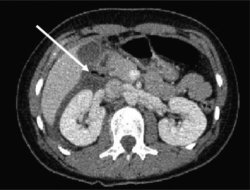 CT of abdomen  showing free air  in right para renal spac 