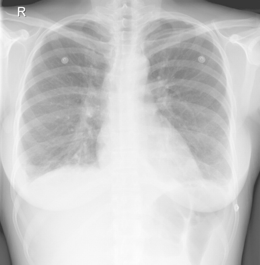 Chest x-ray: Kerley-B lines and mild bilateral pleural | Open-i