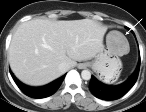 Contrast Enhanced Ct Scan At The Level Of The Gastric C Open I