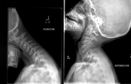 flexion x ray cervical spine