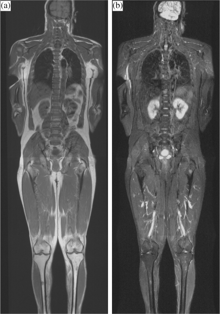 Stage IIIC ovarian cancer with bulky omental cake. The | Open-i