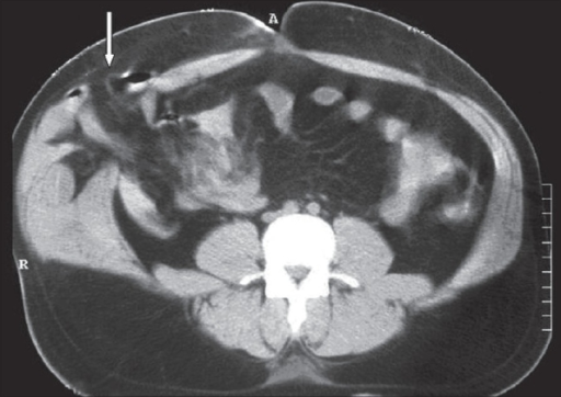 Axial CT of the abdomen: A defect at the anterior abdom | Open-i