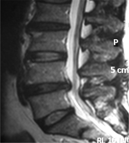 Sagittal plane MRI view showing L4–5 disc protrusion. | Open-i