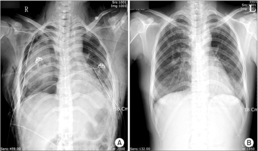 Chest X-ray findings. (A) The initial chest x-ray taken | Open-i